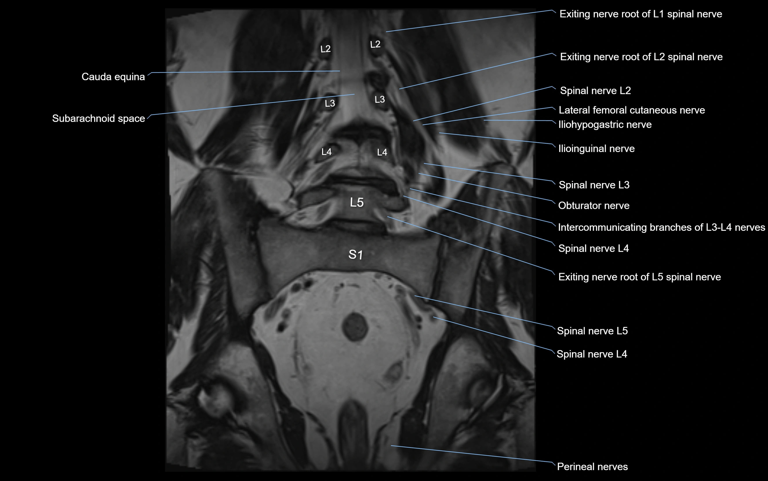 MR lumbosacral plexus cross sectional anatomy 3T  radiology  image-img-09001-00038.webp